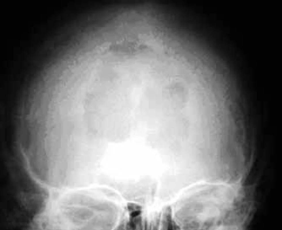 Osteolytic deposit in the skull in a front-rear x-ray image.