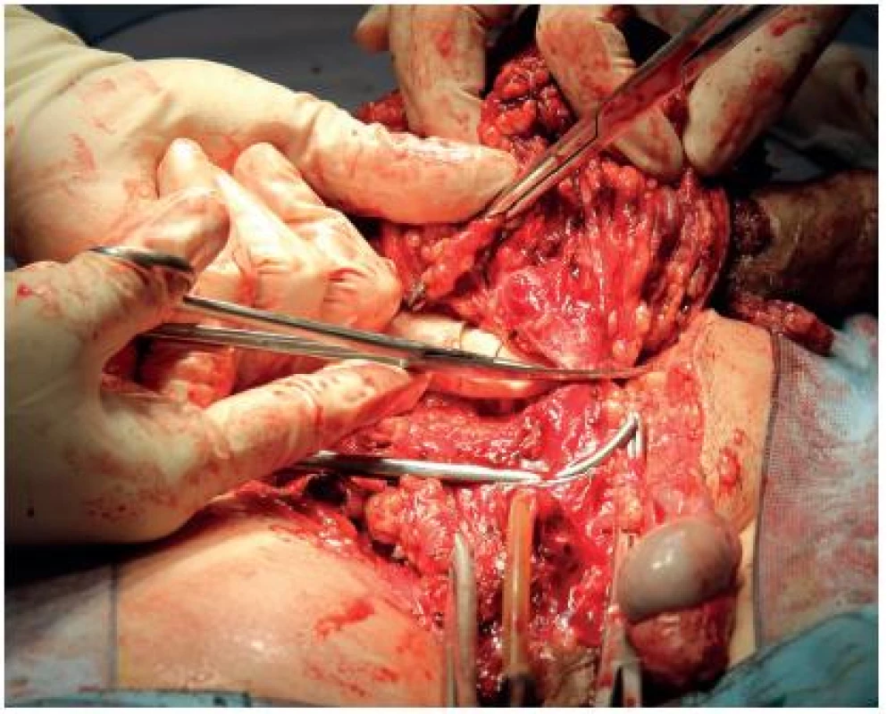 Peroperační snímek, excise ingvinoskrotální oblasti vpravo a penektomie
Fig. 6. Peroperative foto, excision of inguinoscrotal region with penectomy