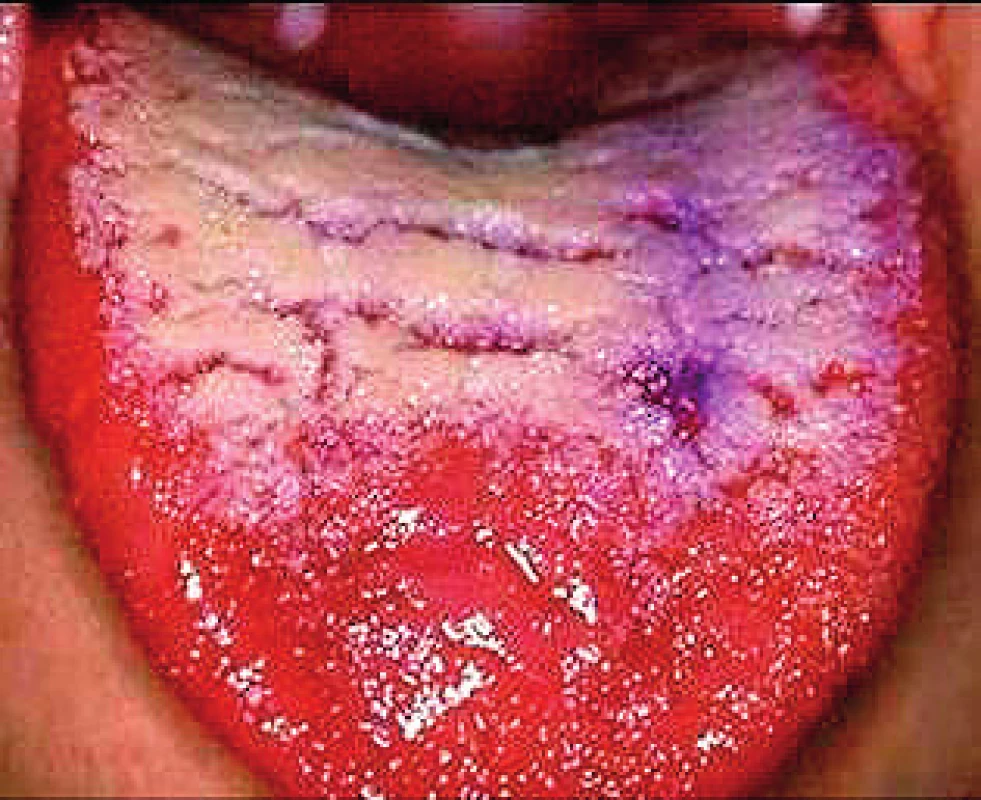 Verukózna leukoplakia na povrchu jazyka. Rozsiahly leukoplakický plát je radiálne prerušený prasklinami, čím vznikajú veruky (Ďurovič)