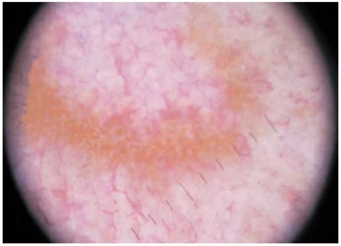 Dermatoskopický nález kožní sarkoidózy