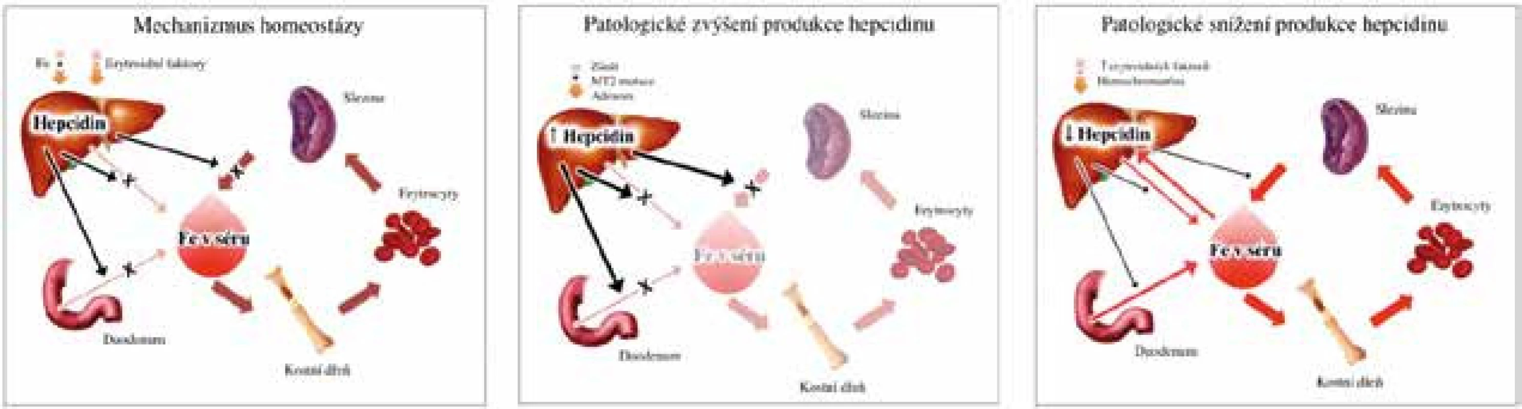 Homeostáza železa v organismu a řízení jeho cirkulace hepcidinem. Hepcidin je produkován v hepatocytech jater v odpovědi na stav železa v organismu (stimulační signál, +) a aktivitu erytropoézy (tlumící signál, -). Hepcidin (černá čára) inhibuje transport železa z enterocytů duodena, makrofágu sleziny a hepatocytů jater (x) a snižuje tak hladinu železa v plazmě. Patologické zvýšení produkce hepcidinu (v důsledku zánětu a inaktivačních mutací matriptázy 2, MT-2) vede k utlumení uvolňování železa z výše zmíněných buněčných kompartmentů a ke snížení jeho hladiny v plazmě, což vede k rozvoji anemie. Naopak při patologickém snížení produkce hepcidinu (v důsledku zvýšených hladin erytroidních faktorů nebo při mutacích genů asociovaných s hemochromatózou) dochází ke zvýšení hladiny železa v plazmě a eventuálnímu rozvoji přetížení organismu železem. (Upraveno dle: Ganz, 2011 [20])