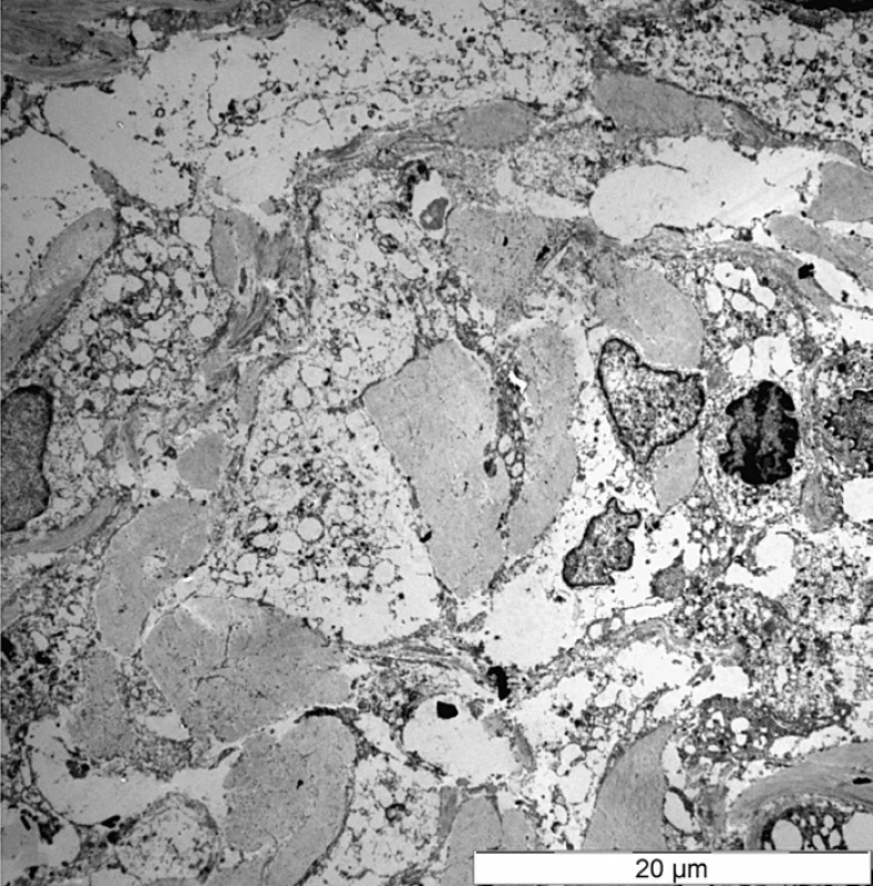 Elektronmikroskopický snímek zobrazující histiocyty s jádry a objemnou zčásti vakuolizovanou cytoplazmu, kde je deponovám elektrodenzní granulární materiál. Patrné jsou i okrsky fibrózy.