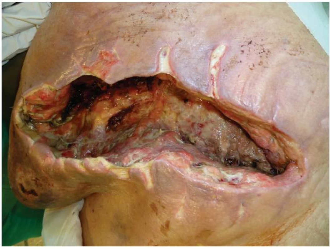 Stav rány před zahájením podtlakové terapie
Fig. 3: The condition of the wound before negative pressure wound therapy (NPWT)