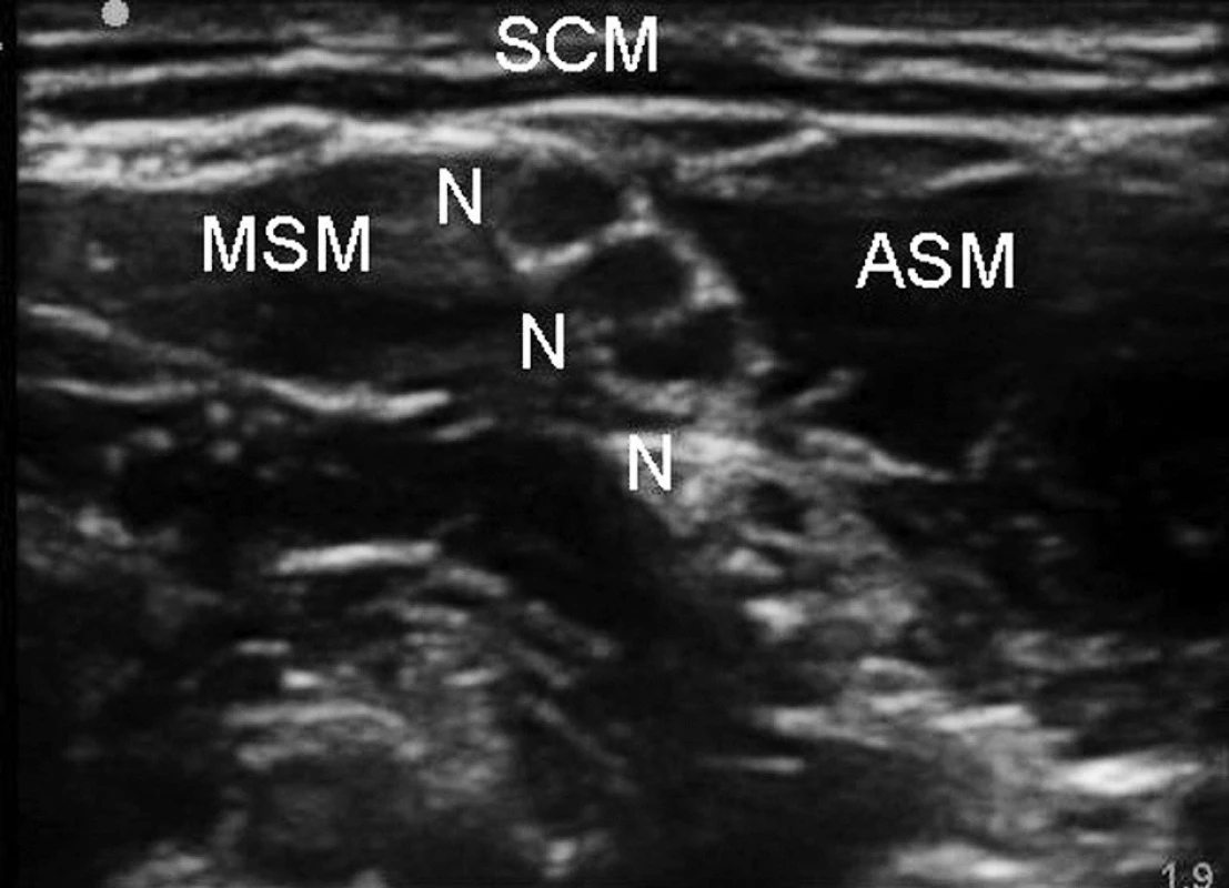 Interskalenická blokáda brachiálního plexu 
Legenda: N – nervové kořeny, ASM – musculus scalenus anterior, MSM – musculus scalenus medius, SCM – musculus sterno - cleidomastoideus