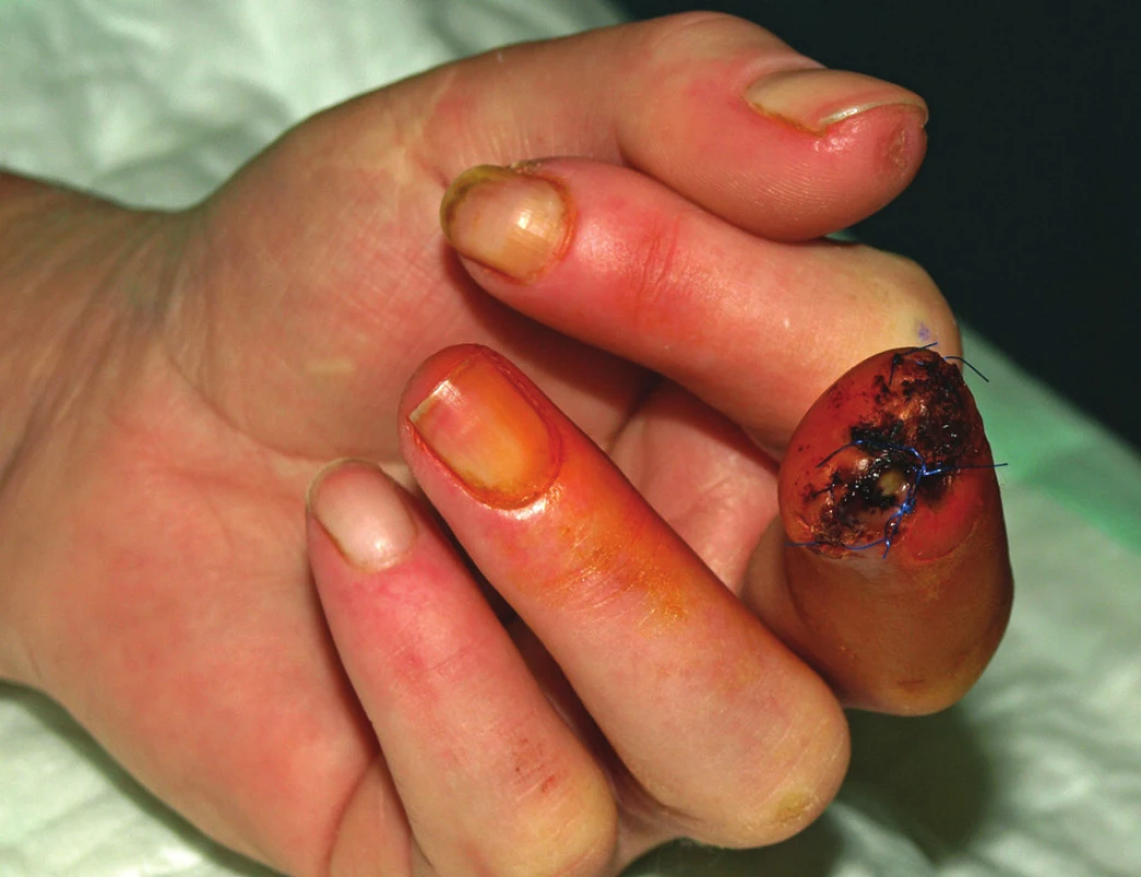 Stav v prosinci 2010.
Po chirurgické amputaci distálního článku 3. prstu levé ruky. Hojení je komplikováno infekcí v ráně s částečnou dehiscencí sutury.