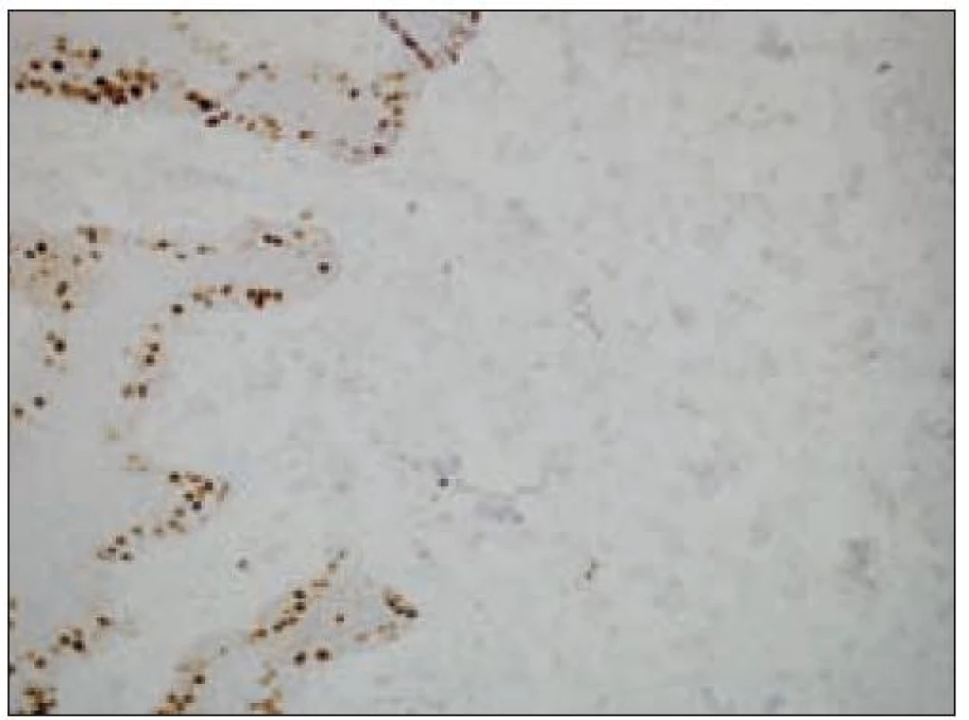 Kožný histiocytóm, nádorové bunky s nulovým proliferačným indexom (imunohistochemický dôkaz Ki-67 antigénu).