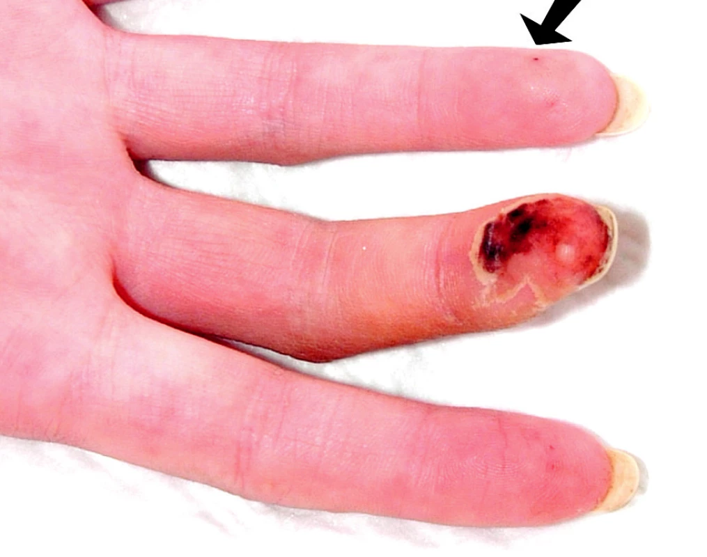 Vaskulitický defekt na prstu ruky, šipkou je označena třískovitá hemoragie.