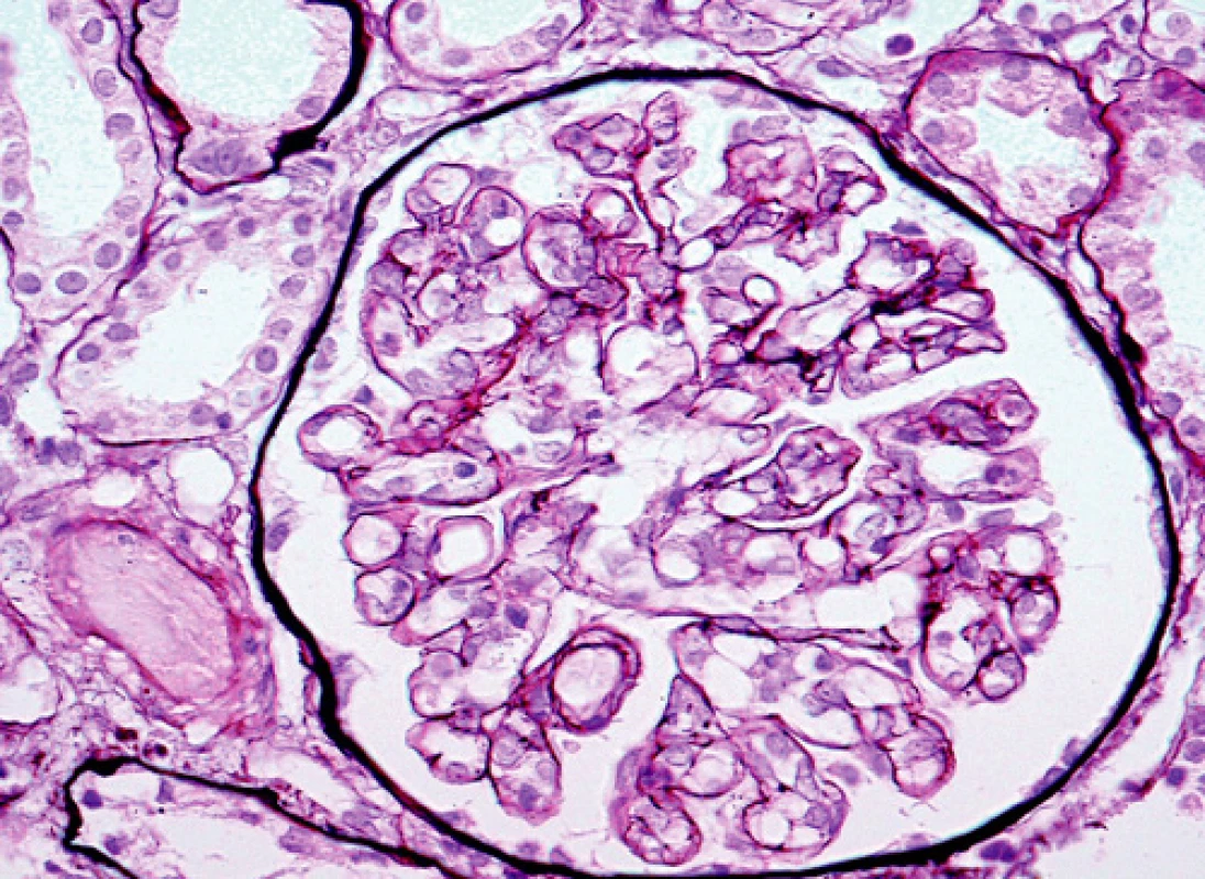 Glomerulus se zduřelými endoteliemi a tvorbou druhé vnitřní bazální membrány, která ložiskově vytváří dvojkontury
(barvení PASM [periodic acid – silver methenamine]; objektiv 40krát) 

