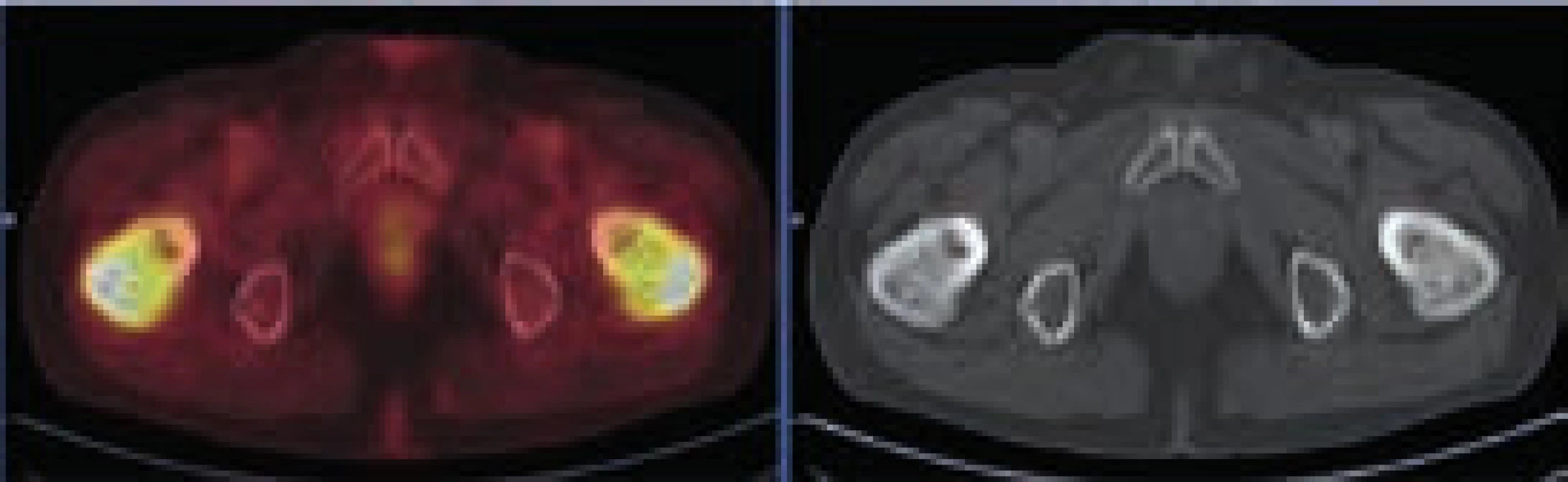 PET-CT zobrazení femorů, axiální řez