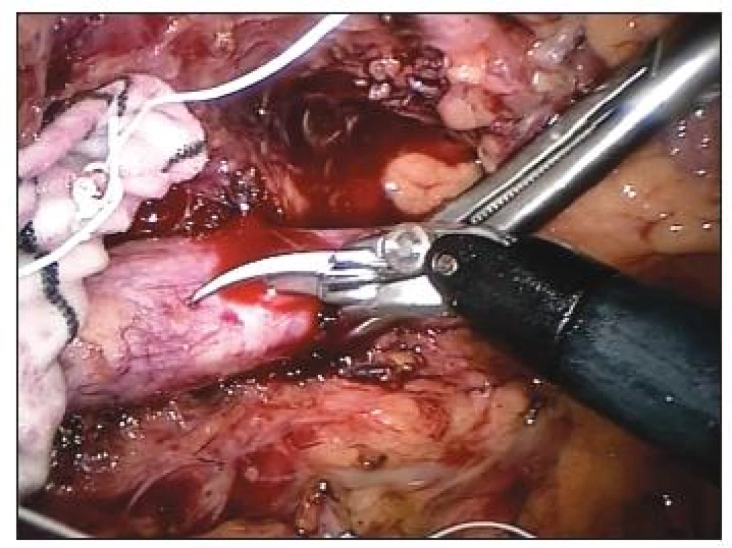 Robotické nůžky – aortotomie
Fig. 1. Robotic scissors – aortotomy
