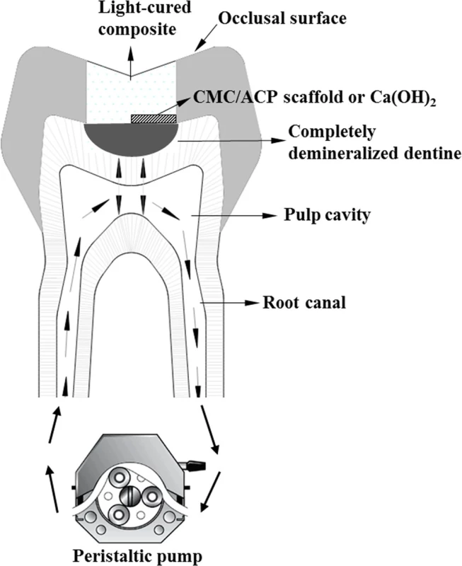The scheme of tooth model of deep caries.
