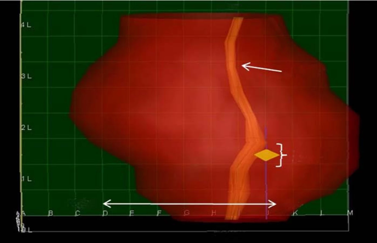 Zobrazení prostaty po 3DM biopsii. Karcinom je zobrazen jako žlutý kosočtverec.
Rovněž je zobrazen průběh močové trubice.