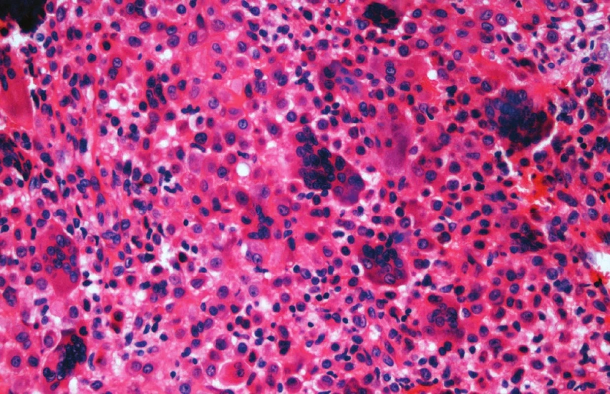 Tzv. agresivní varianta chondroblastomu se od obrovskobuněčného nádoru liší charakterem stromálních elementů, které si zachovávají typické histologické i imunohistochemické charakteristiky (S-100 protein pozitivita) chondroblastů, HE, x200.