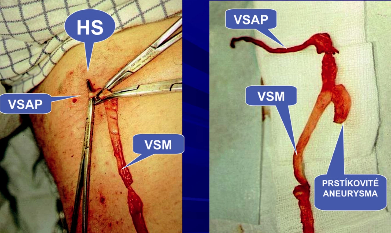 Ambulantní flebektomie. Safénový komplex typ I – z VSM odstupuje v HS VSAP