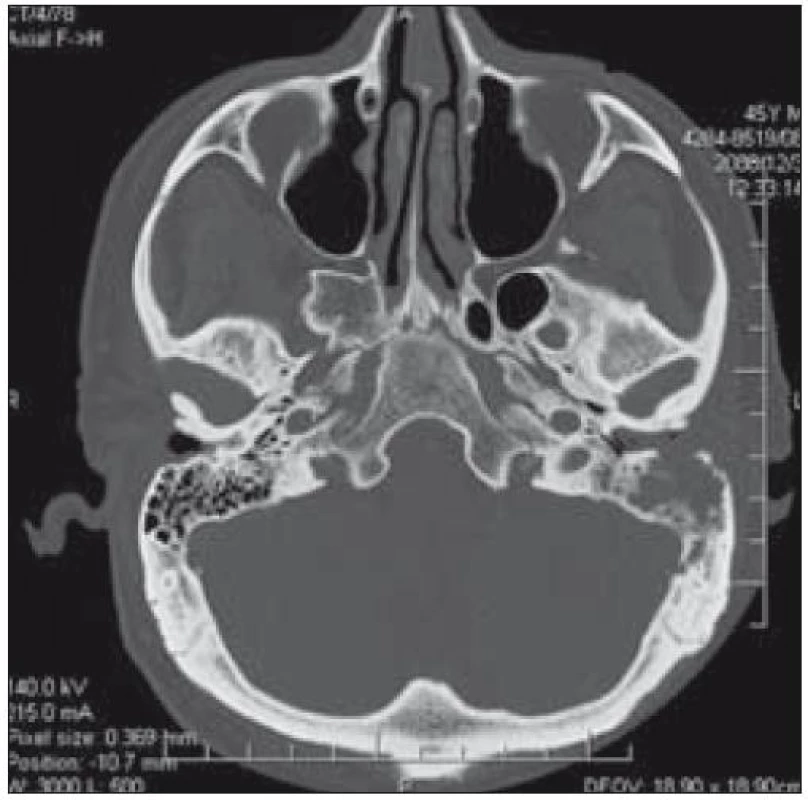 CT lebeční spodiny – zastření zevního zvukovodu s destrukcí jeho dorzální stěny a s rozpadovou dutinou v processus mastoideus o průměru kolem 2 cm u pacienta 2.