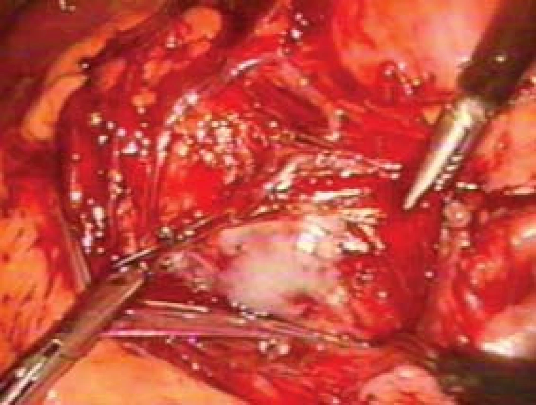 Preparace renální žíly při laparoskopické levostranné adrenalektomi.