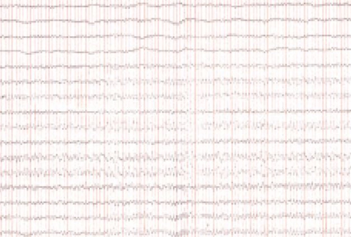 EEG v decembri roku 2005 – rytmická 6 Hz τ-aktivita difúzne, amplitúda do 100 μV.