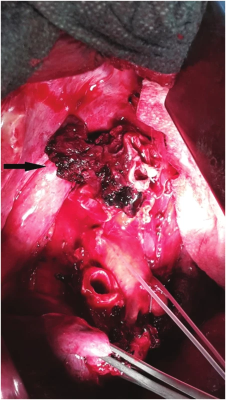 Nádorové postižení kariny, stav po horní lobektomii vpravo
Fig. 3: Tumor of the carina; status after right upper lobectomy