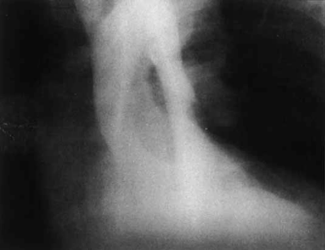 Aortogram v antero-posteriorní projekci u aortální direkce. Pravé lumen je komprimováno neopákním falešným lumen.

