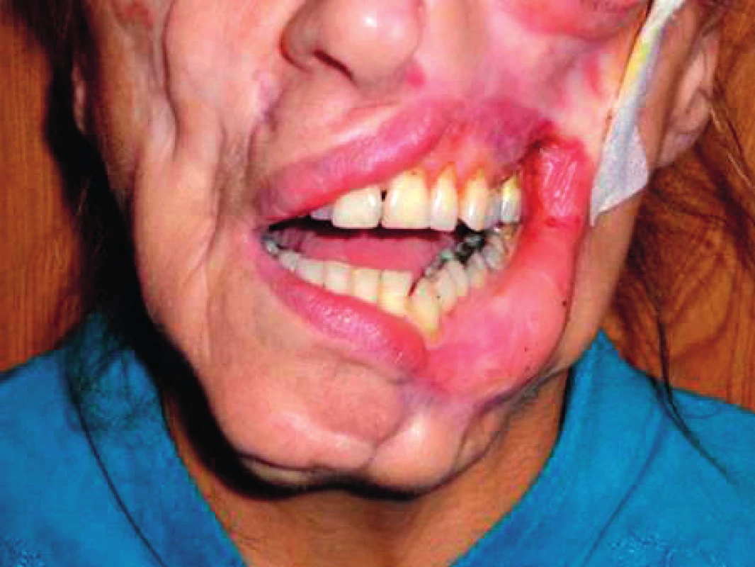 Mutilující defekt levé strany obličeje a brady způsobený organismem Cladosporium cladosporoides s maximálním otevřením úst na méně než 2 cm