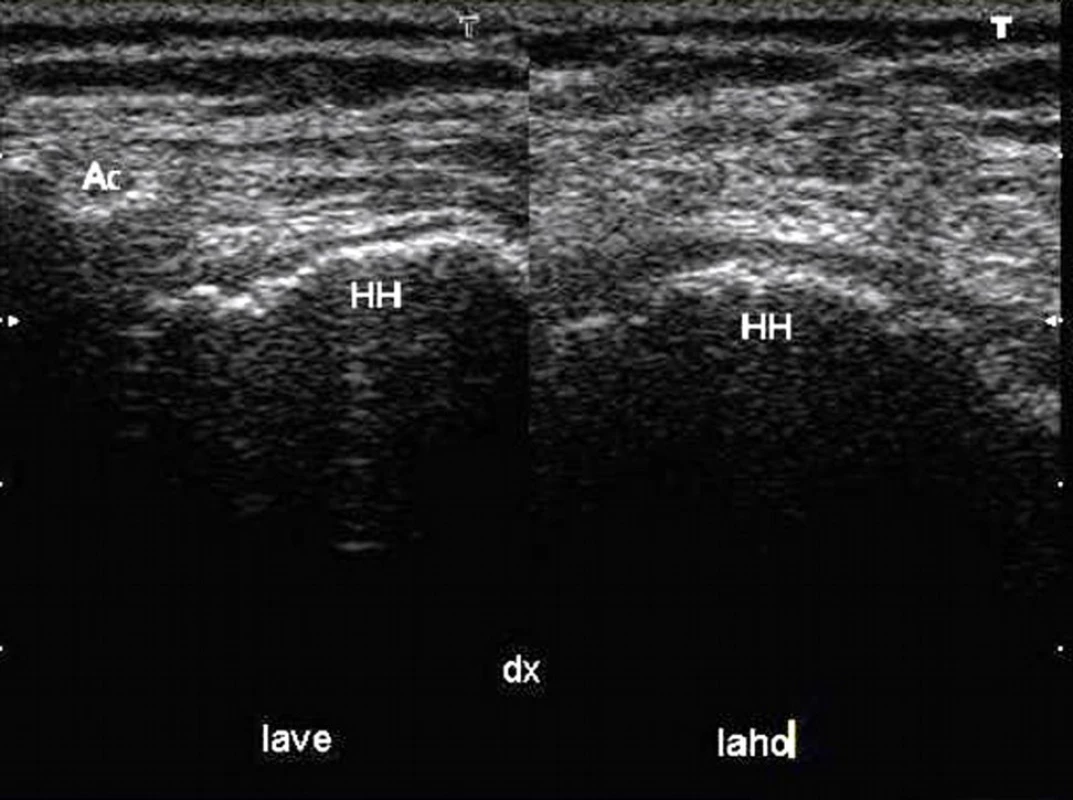 Sonografický obraz rotátorové manžety ramene bez patologie. Ac – Acromion, RM – rotátorová manžeta, HH – hlavice kosti pažní, Lave - laterovertikální pohled, Laho - laterohorizontální pohled, Sin - levá strana