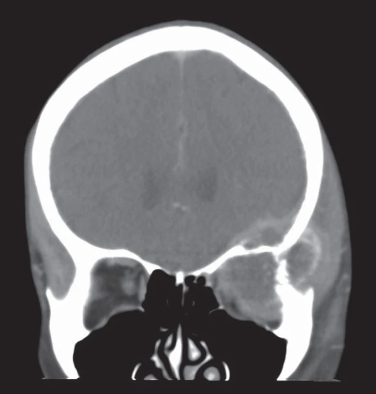 CT hlavy s nálezem progrese metastázy orbity přes systémovou léčbu kapecitabinem 
a lokální paliativní radioterapii ložiska.
