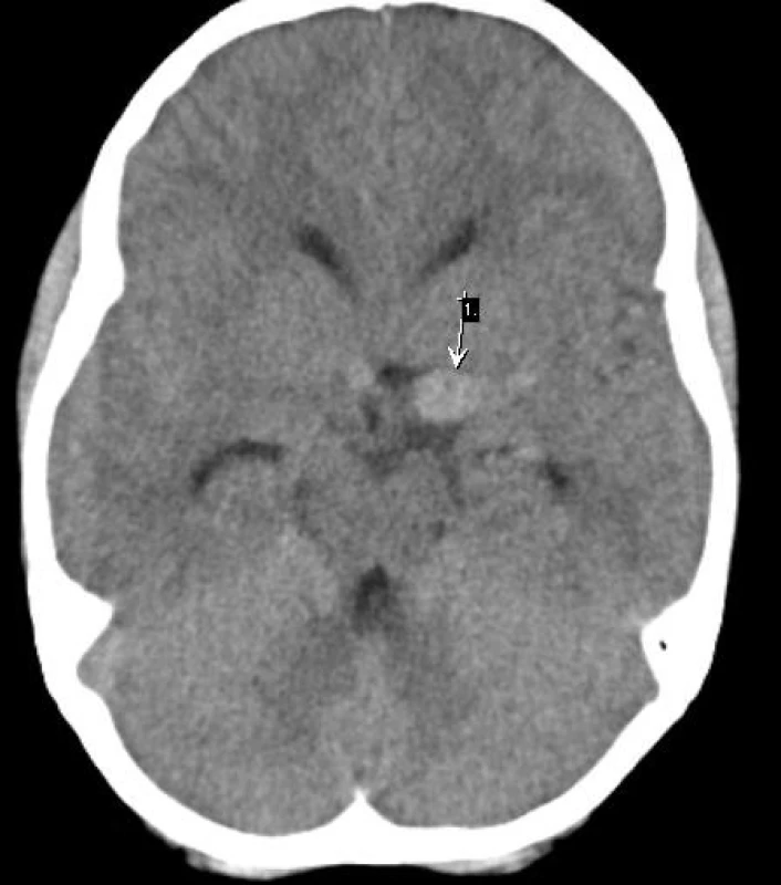Vstupní CT bez SAK s nálezem nativně denzního vaku aneurysmatu (1), štíhlé komory
