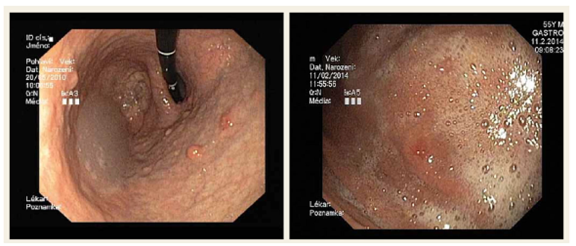Neuroendokrinní nádor žaludku.
Fig. 1. Neuroendocrine tumour of the stomach.