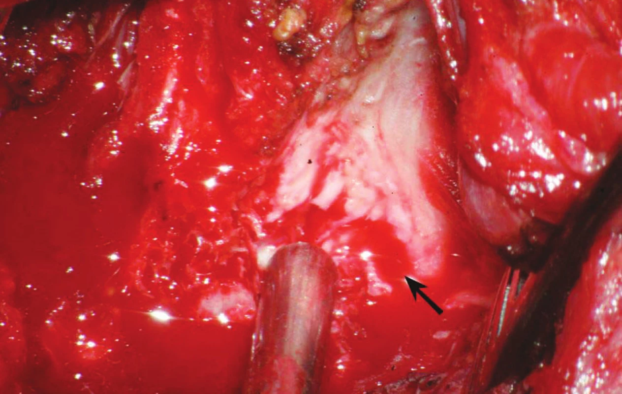 Operační fotografie: šipka ukazuje laceraci dorzální porce a pravé poloviny míchy. Tomu odpovídá klinika hemisyndromu míšního Brownova-Séqurdova typu v kombinaci s kompletním postižením zadních provazců.