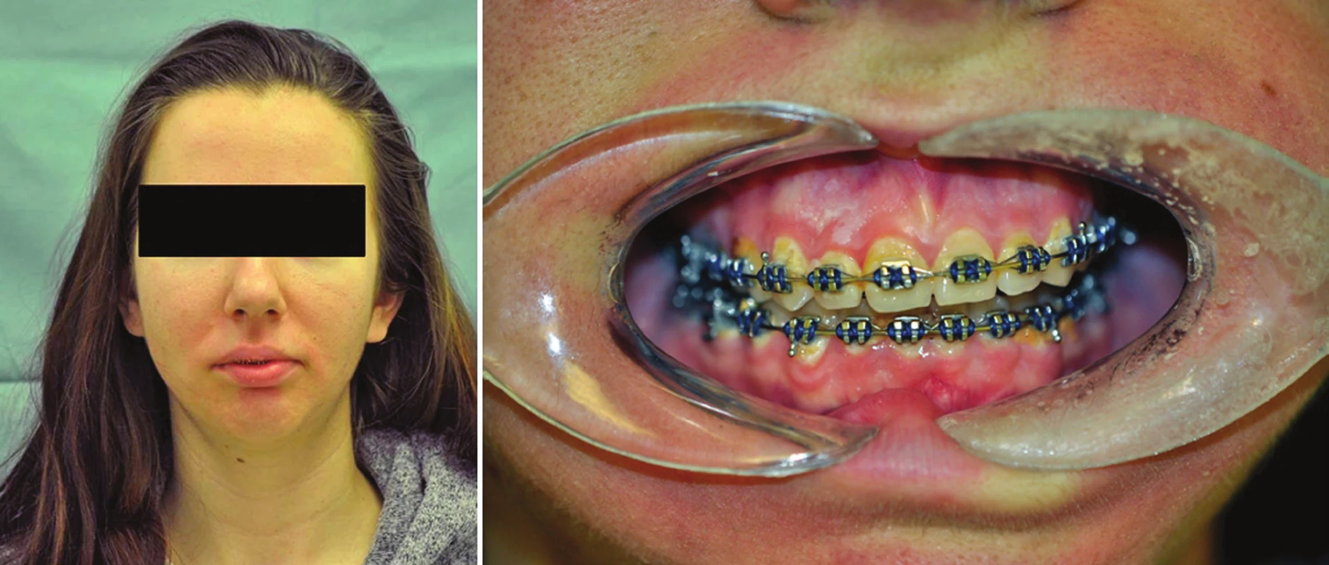 Pacientka s laterogenií doleva. Obrázek vlevo pohled „en face“, vpravo obraz skusu s nasazeným fixním ortodontickým aparátkem.