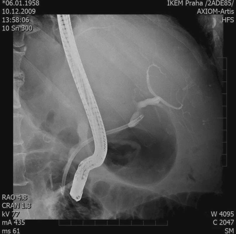 ERCP – stenóza žlučovodu, 1 stent
Fig. 3. ERCP – biliary duct stenosis, 1 stent