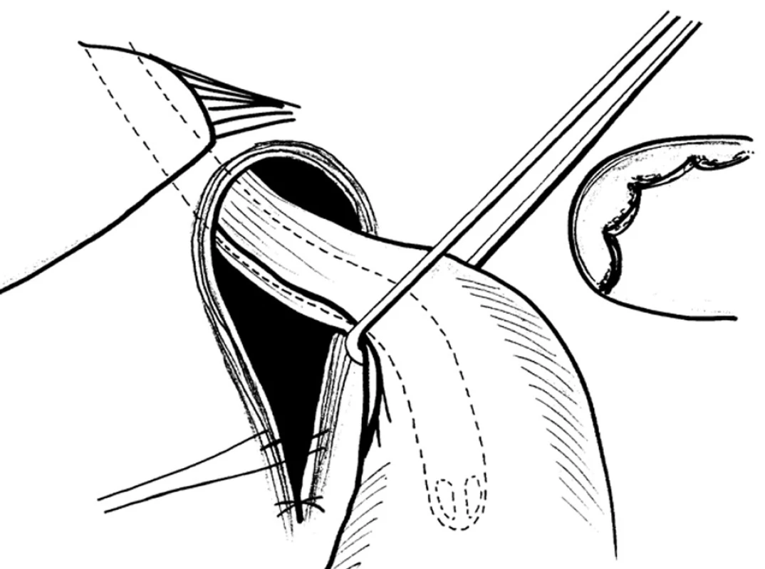 Klasická zadní hiátorafie za pomoci trakce
Fig. 18: Posterior hiatoraphy with the aid of the traction