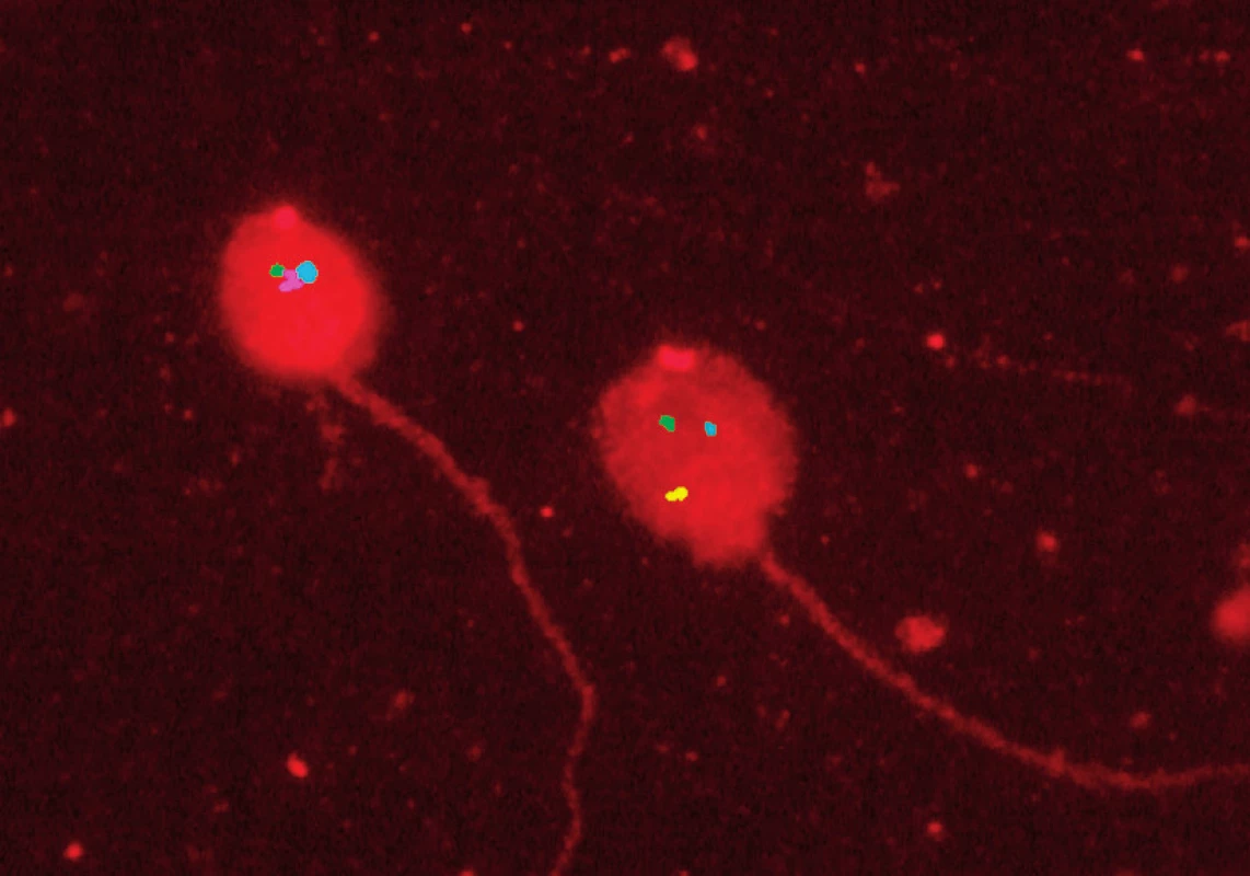 Fluorescenční in situ hybridizace na spermiích: signály pro chromozomy 21 (zelený), 18 (modrý), X (růžový), 13 (červený) a Y (žlutý)
Fig. 1. Fluorescence in situ hybridization in sperms: signals for chromosomes 21 (green), 18 (blue), X (pink), 13 (red) and Y (yellow)