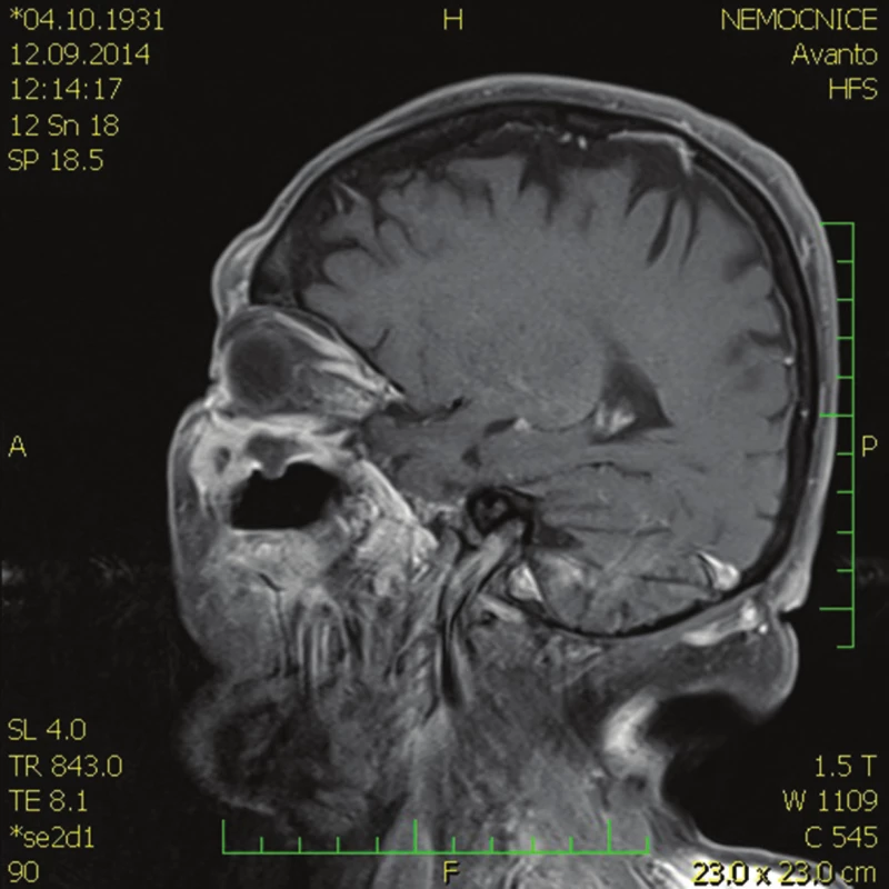 MR hlavy – sagitální řez