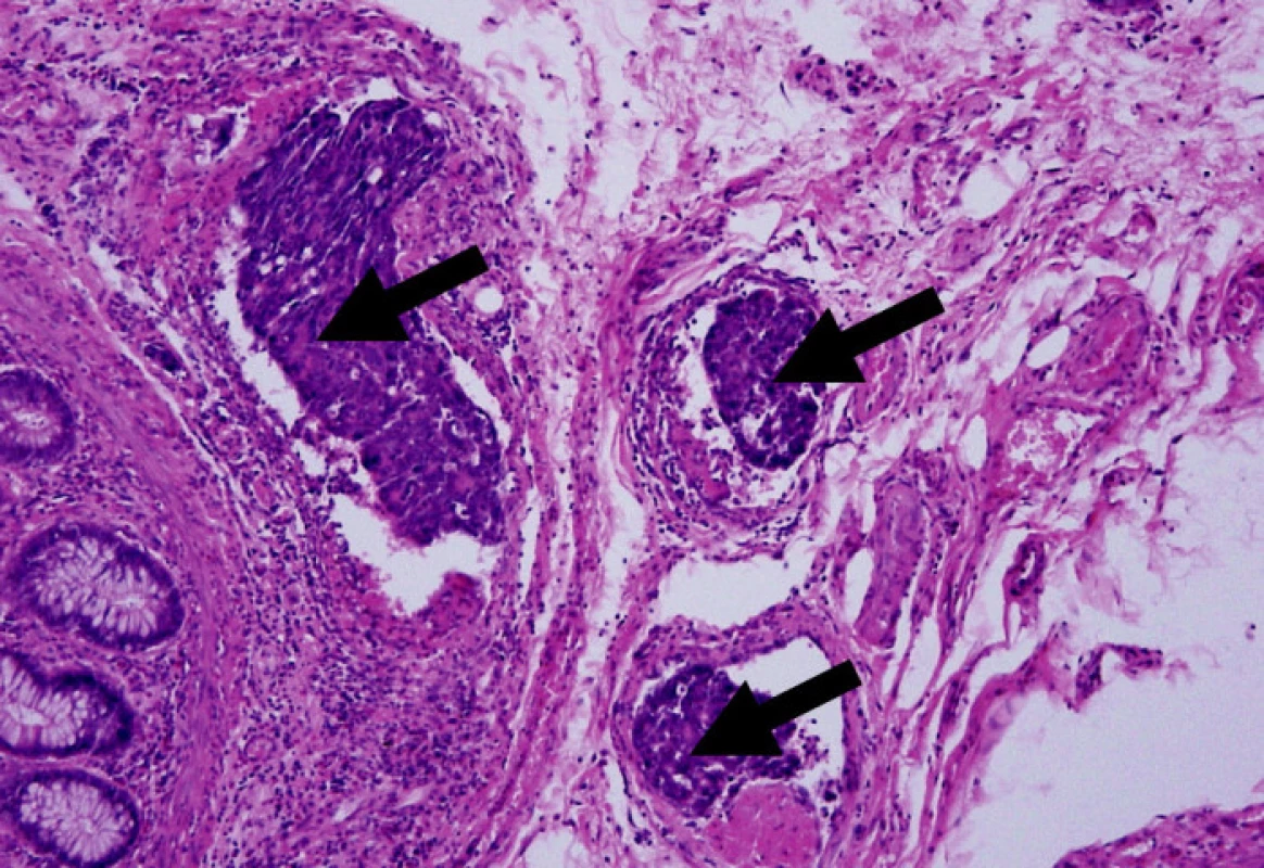 Lymfangioinvaze karcinomu rekta v mezorektální tukové tkáni (HE, 100x)
Fig. 1. Lymphangioinvasion of rectal carcinoma in the mesorectal fat tissue (HE, 100x)