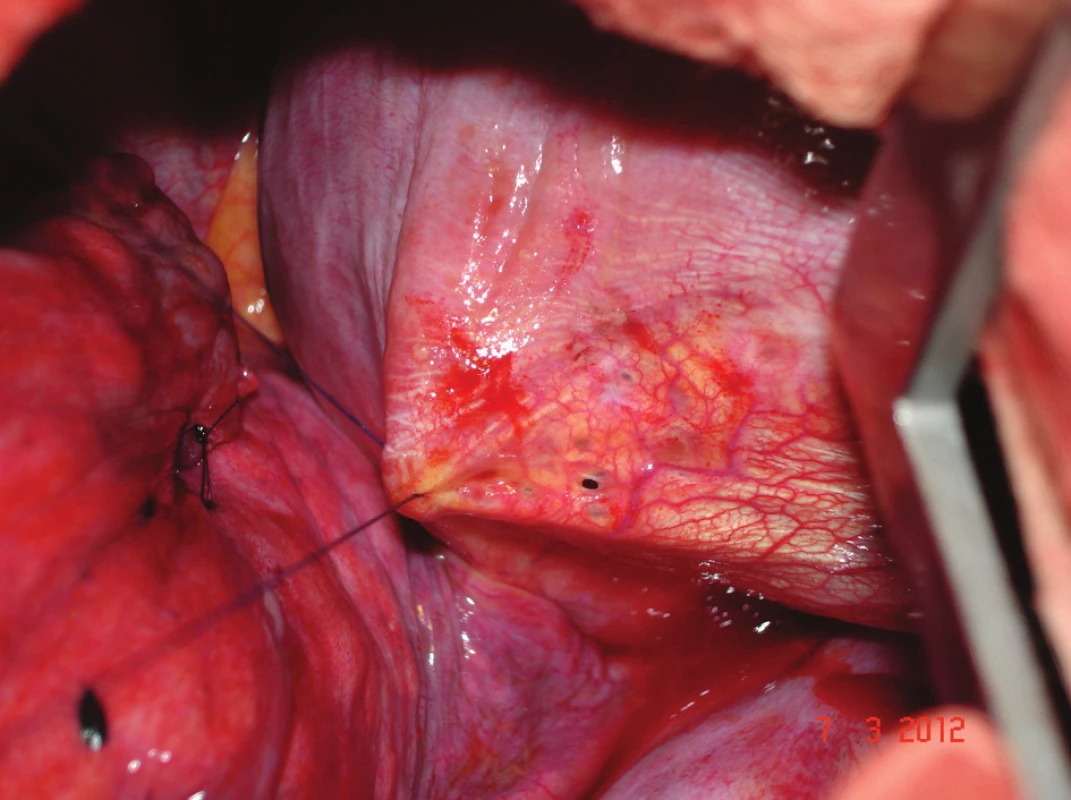 Detail jednoho z bráničních defektů – operační foto
Fig. 2: Detail of one of the defects in the diaphragm – photo from the operation