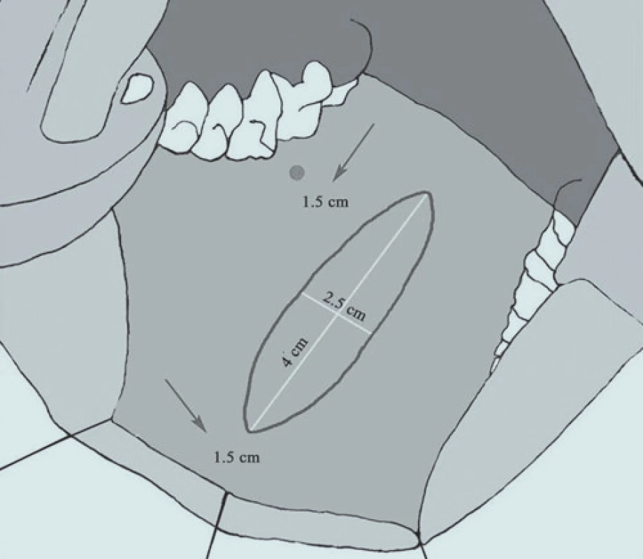 Štěp je 4 cm dlouhý a 2,5 cm široký, začíná 1,5 cm od Stensenova vývodu a 1,5 cm od okraje tváře.