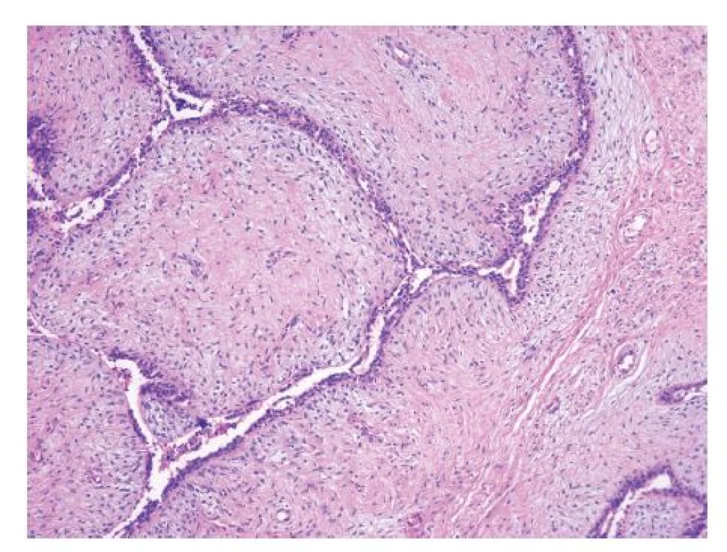 Mamografie – maligní fyloidní tumor v centru levého prsu 5x6 cm
Fig. 3: Mammography – malignant phyllodes tumour in the centre of the left breast, 5x6 cm