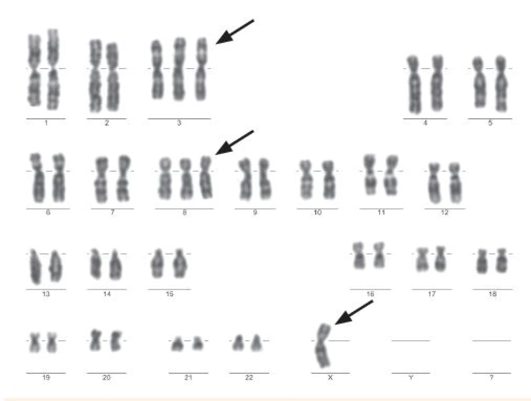 Ženský karyotyp 46, X, -X, +3, +8 použitím G-bandu 
(Odd. lekárskej genetiky, NOÚ, Bratislava).