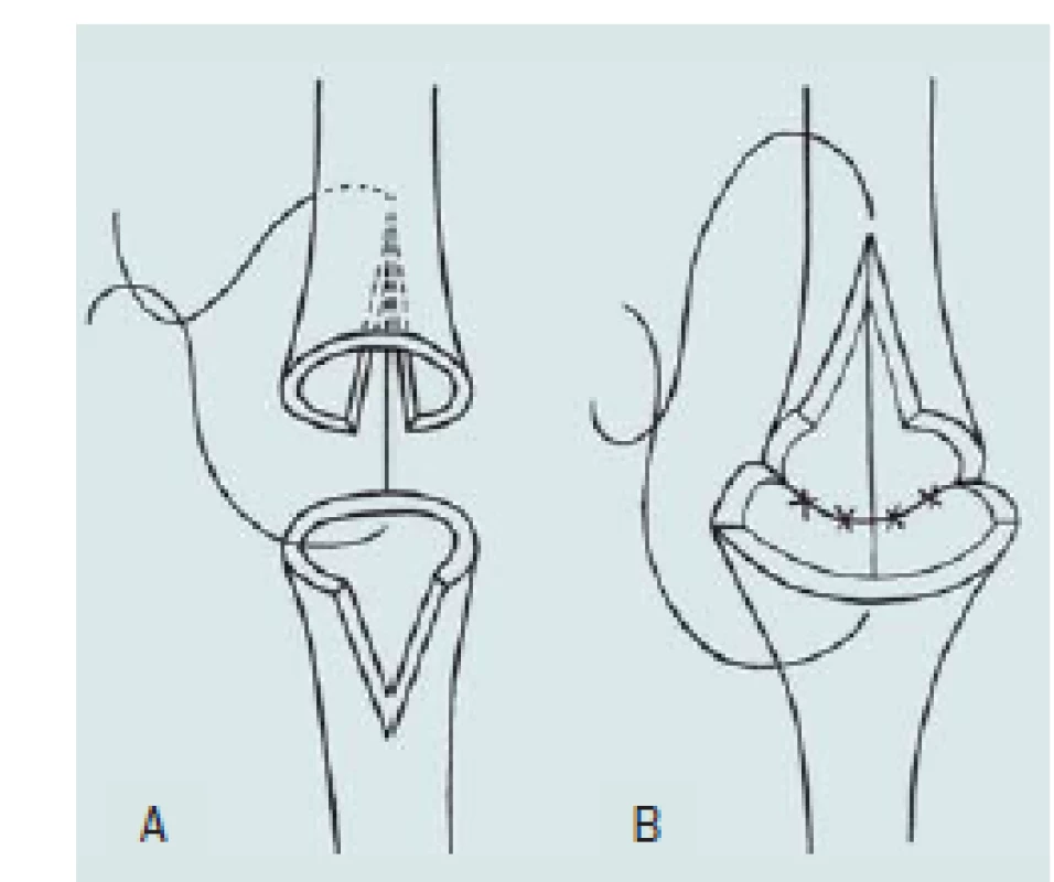 Anastomóza konec ke konci. A – Přerušení močové trubice a spatulace obou uretrálních konců. B – Přímá anastomóza obou konců bulbární uretry.