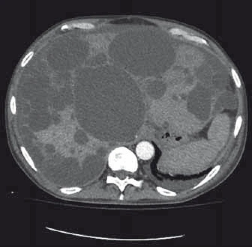 Polycystické postižení jater a ledvin, CT – transverzální řez.
Fig. 1. Polycystic liver and kidney disease, CT – transverse plane.