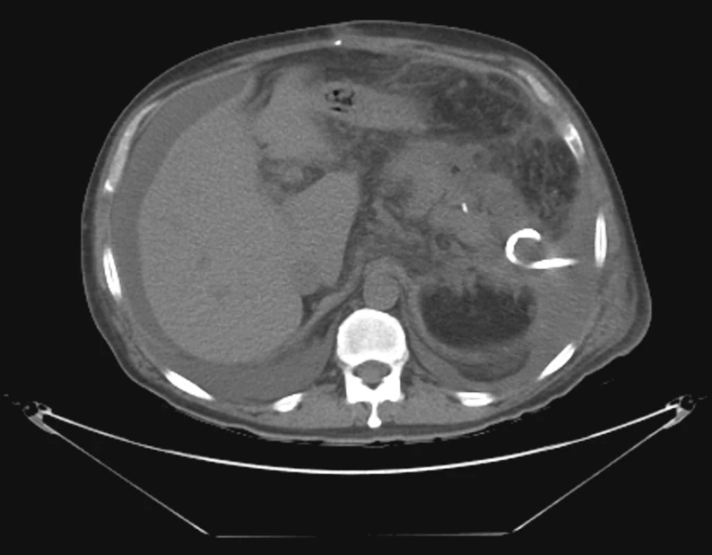 Drenáž abscesu v levém hypochondriu perkutánně pod CT kontrolou
Fig. 3. CT-controlled drainage of an abscess in the left hypochondrium
