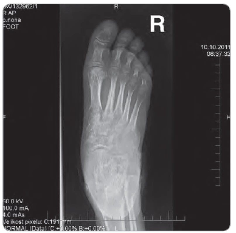 Osteolýza os cuboideum a okolitých cuboideometatarzálnych kĺbov na RTG pravej nohy.