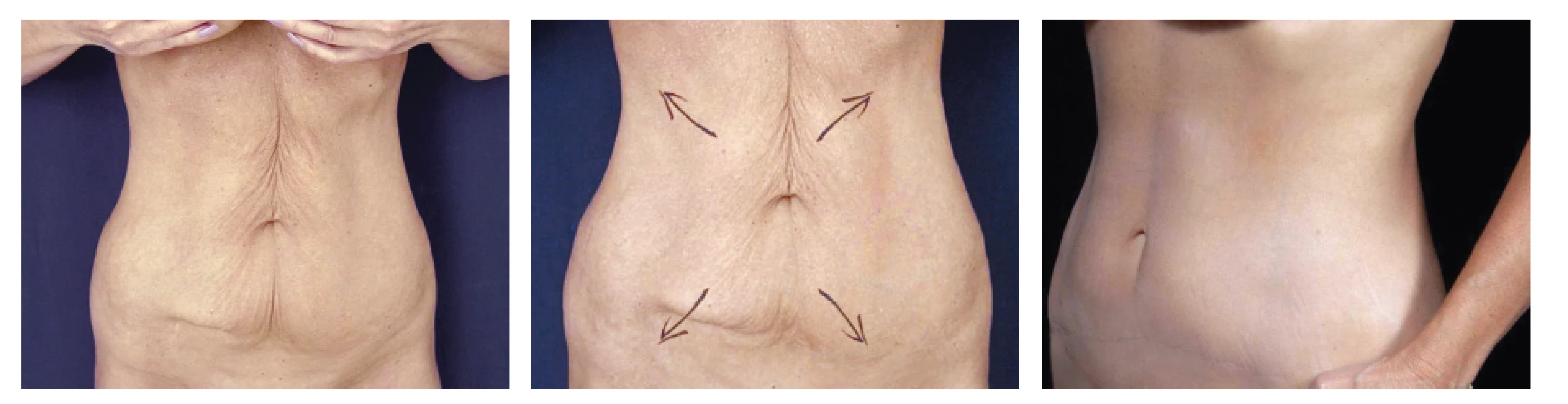 Horní a dolní miniabdominoplastika u 59 leté ženy
Fig. 6: Upper and lower abdominoplasty in a 59 year old female