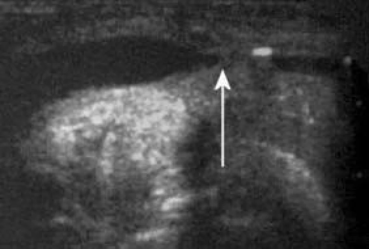USG-uretrografie. Stenóza bulbární části močové trubice zobrazená pomocí ultrazvukové uretrografie (šipka).