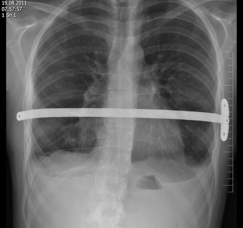 Pooperační snímek hrudníku po implantaci dlahy se stabilizátorem
Fig. 4: Postoperative chest X-ray after the metal bar insertion with a stabilizer