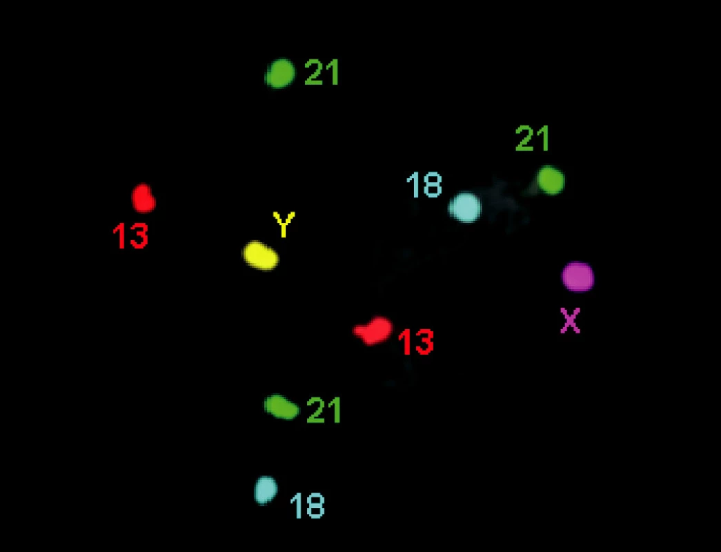 FISH chromozómů 13, 18 a 21 (3 × 21)