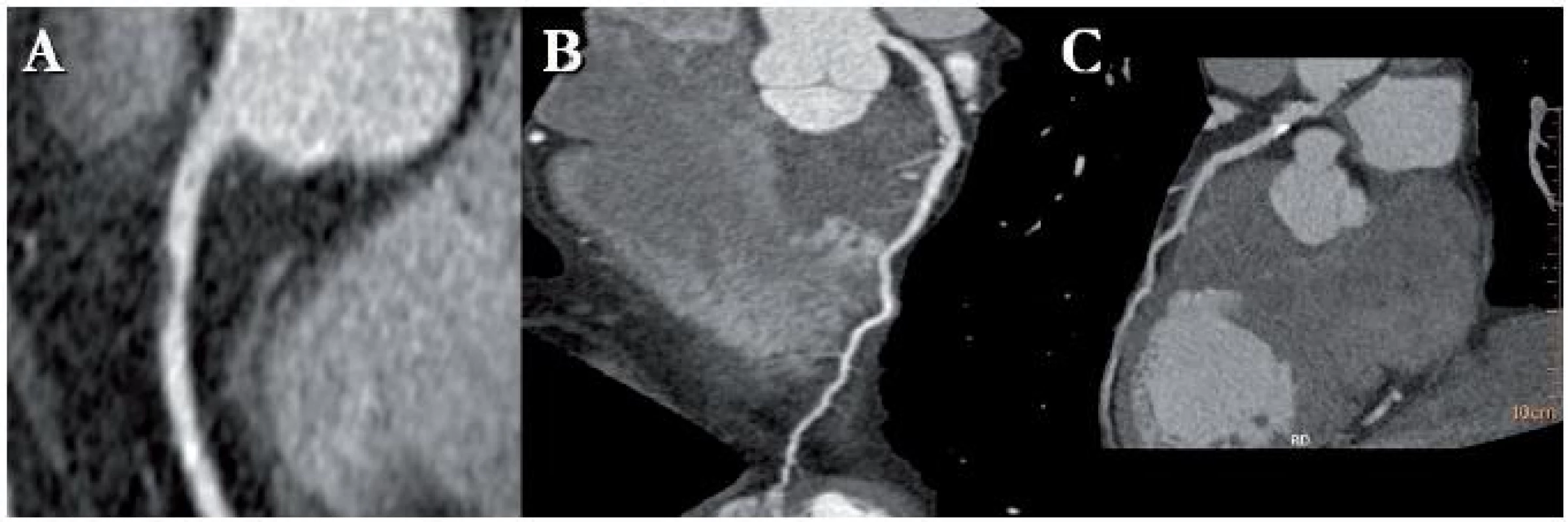 Pacient s měkkým aterosklerotickým plátem (A), smíšeným aterosklerotickým plátem (B) a  kalcifikovaným plátem (C)
