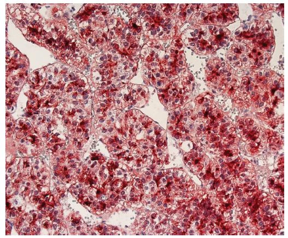 Hepatocelulární karcinom s difúzně pozitivním cytoplazmatickým a kanalikulárním imunohistochemickým průkazem glypicanu-3. Zvětšení, objektiv 20x.