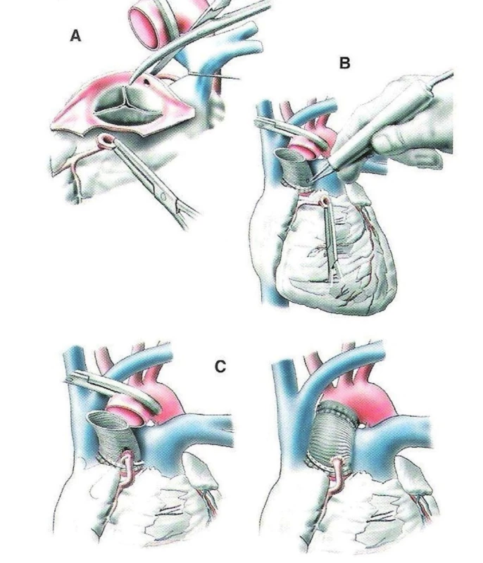 Náhrada vzestupné aorty a aortální chlopně conduitem (1)